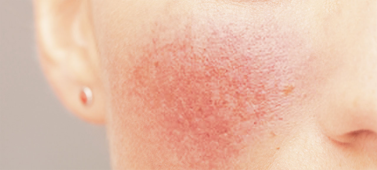 Acne Rosacea - Fighting with rosacea