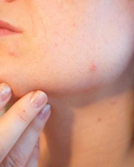 Blackheads - Get rid of them