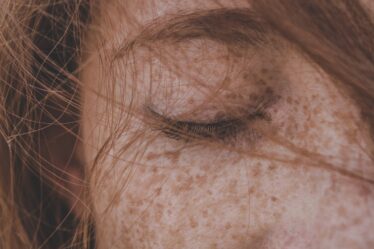 Remove Freckles - Getting rid of freckles