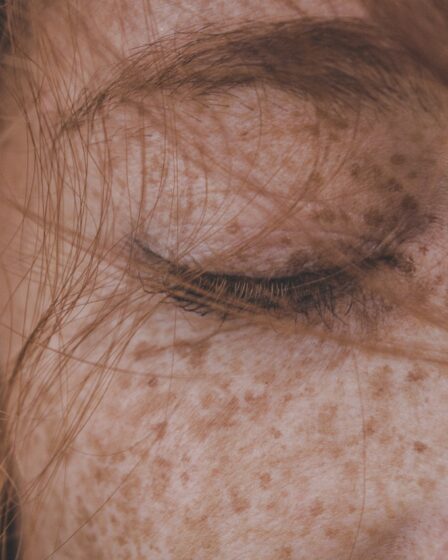 Remove Freckles - Getting rid of freckles