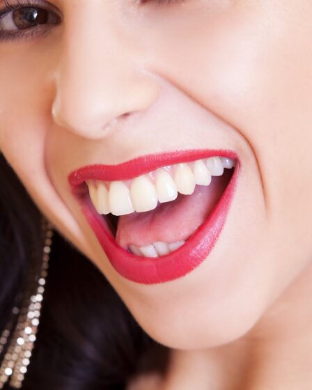 Tooth Whitening